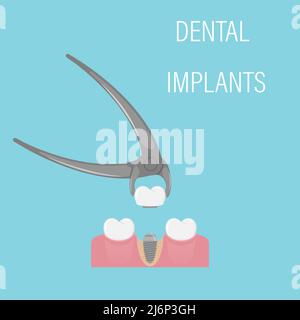 Installation von Zahnimplantaten. Ästhetische Zahnheilkunde, moderne Medizin. Implantierte Krone in der Zepe. Eine Schraube im Gummi mit einem Knochen. Wiederherstellung des Gebisses Stock Vektor