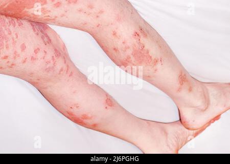 Akute Psoriasis, schwere Rötung der Haut, eine Autoimmunerkrankung, unheilbare dermatologische Hautkrankheit. Große rote, entzündete, schuppige Ausschlag auf die Beine des Mannes Stockfoto