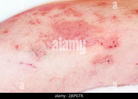 Akute Psoriasis, schwere Rötung der Haut, eine Autoimmunerkrankung, unheilbare dermatologische Hautkrankheit. Große rote, entzündete, schuppige Ausschlag auf die Beine des Mannes Stockfoto