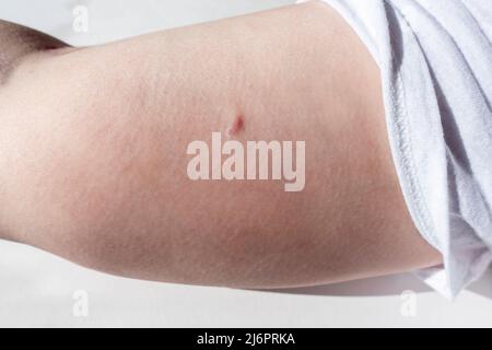 Nahaufnahme der Geburtskontrolle einer Frau, die mehrere Monate nach der Entfernung des Geräts eine Narbe aus dem Implantat entfernt hat Stockfoto