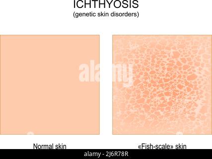 Ichthyose. Genetische Hauterkrankungen. Normal und die Haut einer Person mit Ichthyose ist rau, trocken und schuppig. „Fish-Scale“-Haut. vektorgrafik Stock Vektor