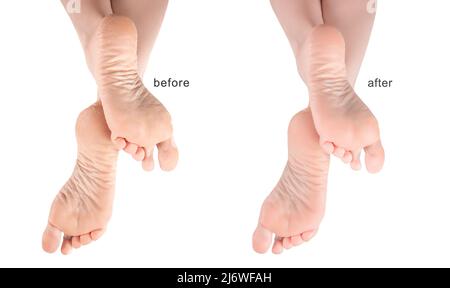 Füße mit trockener Haut vor und nach der Behandlung. Fußcreme, Feuchtigkeitscreme. Trockene und rissige Fußsohlen. Weibliche Beine in einer eleganten Position. Schmerzende Haut o Stockfoto