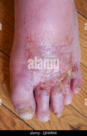 Der Fuß des Mannes ist von der Fußerkrankung des Athleten (Tinea pedis) betroffen, Frankreich Stockfoto