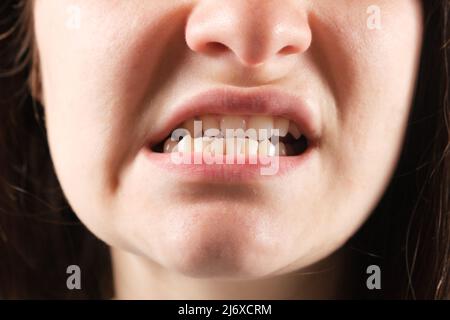 Patient mit ausgeruhter Kiefer und Malokklusion, Funktionsstörung des Kiefergelenks, Nahaufnahme. Stockfoto