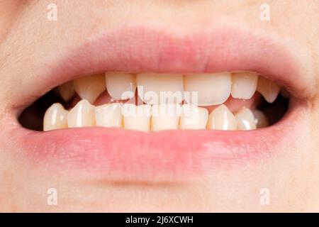 Patient mit ausgeruhter Kiefer und Malokklusion, Funktionsstörung des Kiefergelenks, Nahaufnahme. Stockfoto