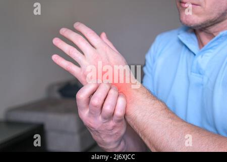 Das Konzept der Dermatitis, Ekzeme, Allergien, Psoriasis. Ein Mann kratzt an einer juckenden Hand. Nahaufnahme eines Mannes mit einem juckenden Ausschlag am Arm, der Betroffene Stockfoto
