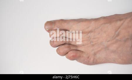 Nahaufnahme Zehennagelpilz isoliert auf weißem Hintergrund Stockfoto