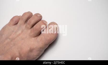 Nahaufnahme Zehennagelpilz isoliert auf weißem Hintergrund Stockfoto