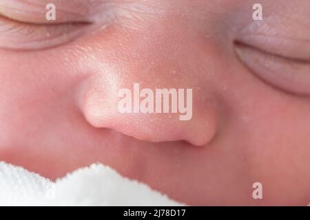 Miliarakne an der Nase eines Neugeborenen. Hautausschläge, Flecken und kleine Pickel am Körper eines Kindes bei der Geburt. Gesundheit von Säuglingen und Körperpflege Stockfoto