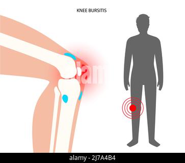 Kniebursitis, konzeptionelle Illustration Stockfoto