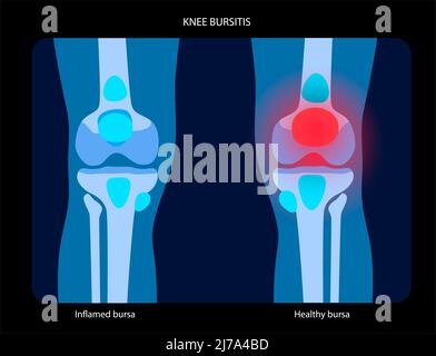 Kniebursitis, konzeptionelle Illustration Stockfoto