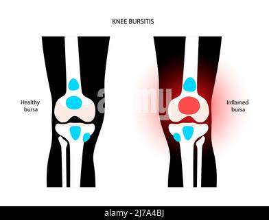 Kniebursitis, konzeptionelle Illustration Stockfoto