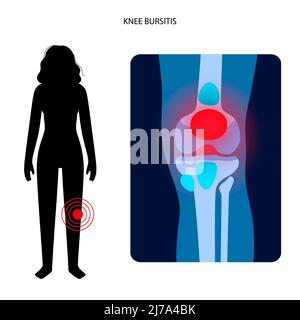 Kniebursitis, konzeptionelle Illustration Stockfoto