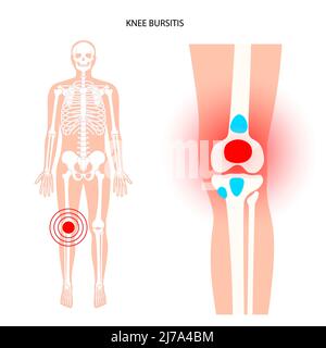 Kniebursitis, konzeptionelle Illustration Stockfoto