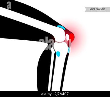 Kniebursitis, konzeptionelle Illustration Stockfoto