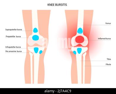 Kniebursitis, konzeptionelle Illustration Stockfoto