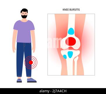 Kniebursitis, konzeptionelle Illustration Stockfoto