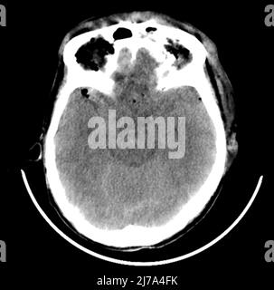 Traumatische Hirnverletzungen, CT-Scan Stockfoto