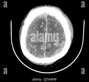 Traumatische Hirnverletzungen, CT-Scan Stockfoto