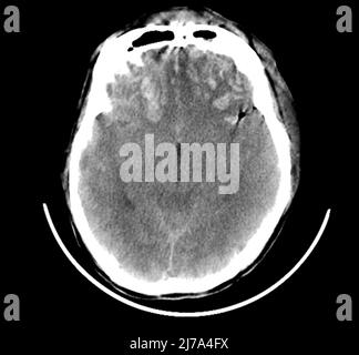 Traumatische Hirnverletzungen, CT-Scan Stockfoto