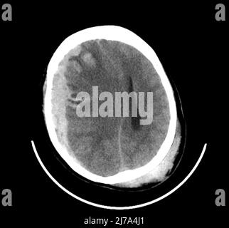 Traumatische Hirnverletzungen, CT-Scan Stockfoto