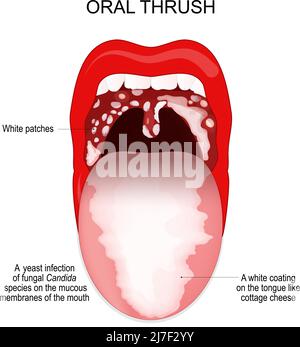 Mundsoor. Eine Hefeinfektion von Pilzarten der Candida-Art an den Mundschleimhäuten. Eine weiße Beschichtung auf der Zunge wie Hüttenkäse. Stock Vektor