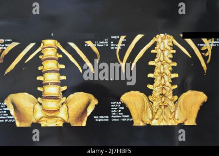 Computertomographie. Älterer Mann mit Rückenproblemen, CT-Scan der Lendenwirbelsäule, lumbosciatische Schmerzen, Brasilien, Südamerika Stockfoto