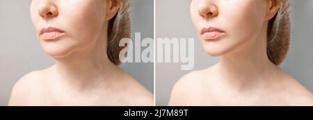 Weibliches Doppelkinn vor und nach der Korrektur. Korrektur der Kinn Form Fettabsaugung des Halses. Das Ergebnis des Eingriffs in der Klinik von Stockfoto
