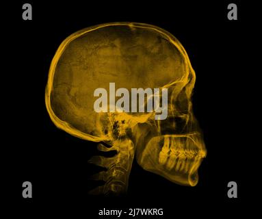 Menschlicher Schädel. Gelbes Röntgenbild isoliert auf schwarzem Hintergrund Stockfoto