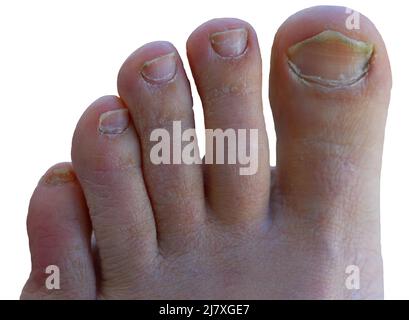 Makroaufnahme eines männlichen Fußes mit gelbem hässlichem Pilz auf Zehennägeln isoliert auf weißem Hintergrund. Pilznagelinfektion. Fortgeschrittenes Krankheitsstadium. Oben vi Stockfoto