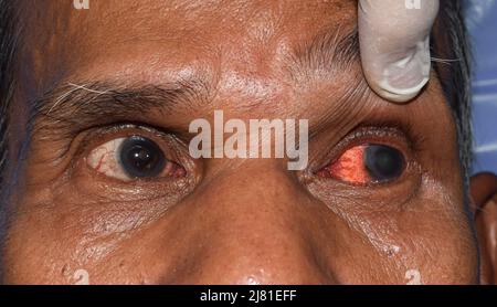 Hornhautinfektion oder Geschwulst genannt Keratitis bei asiatischen alten Mann. Stockfoto