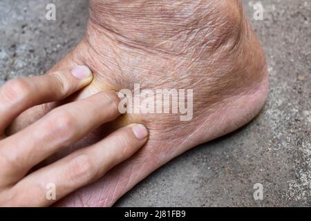 Lochfraß-Ödem der unteren Extremität. Geschwollenes Bein eines alten asiatischen Mannes. Stockfoto