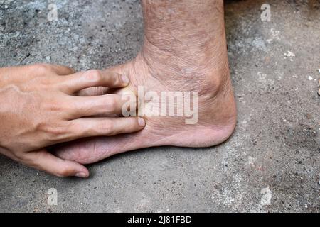 Lochfraß-Ödem der unteren Extremität. Geschwollenes Bein eines alten asiatischen Mannes. Stockfoto