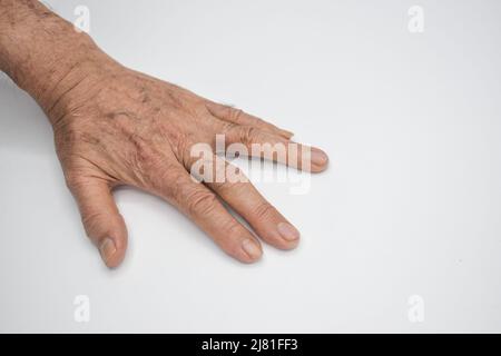 Spastische Hand. Spastizität der Handmuskulatur. Konzept der Handgesundheit. Stockfoto