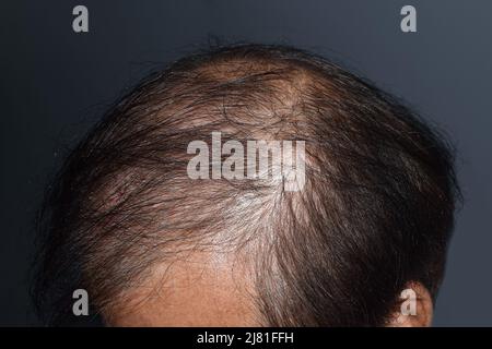 Dünner werdendes oder spärliches Haar, Haarausfall nach männlichem Muster im südostasiatischen, chinesischen älteren Mann. Stockfoto