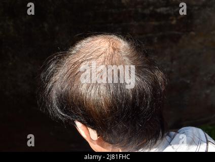 Dünner werdendes oder spärliches Haar, Haarausfall nach männlichem Muster im südostasiatischen, chinesischen älteren Mann. Stockfoto