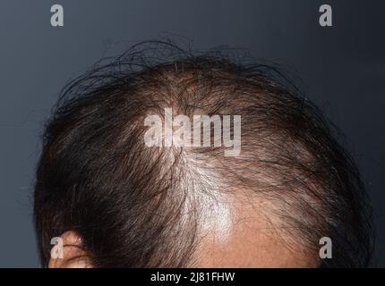 Dünner werdendes oder spärliches Haar, Haarausfall nach männlichem Muster im südostasiatischen, chinesischen älteren Mann. Stockfoto