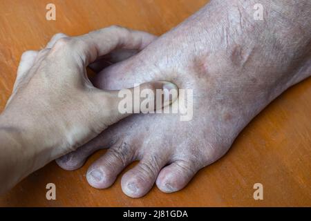 Lochfraß-Ödem der unteren Extremität. Geschwollenes Bein eines alten asiatischen Mannes. Stockfoto