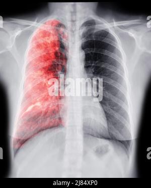 Röntgenaufnahme des Brustkorbs mit Lunge 3D zur Diagnose TB, Tuberkulose und Covid-19. Stockfoto