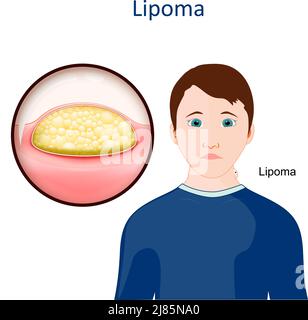 Lipom. Hauterkrankung. Nahaufnahme eines Wachstums von Fettgewebe unter der menschlichen Haut. Vektorgrafik Stock Vektor