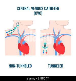 Zentralvenöser Katheter, Abbildung Stockfoto