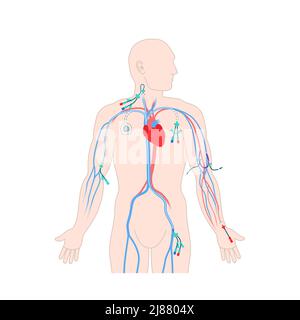 Zentralvenöser Katheter, Abbildung Stockfoto