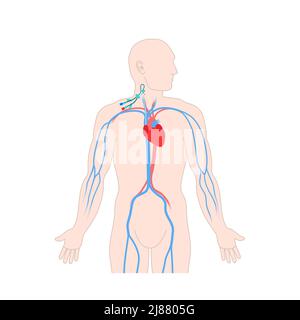 Zentralvenöser Katheter, Abbildung Stockfoto