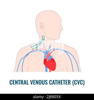 Zentralvenöser Katheter, Abbildung Stockfoto
