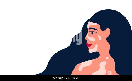 Schöne Frau mit Vitiligo Pigment Haut und hat eine Menge von blauen Haaren Vektor-Illustration Stock Vektor