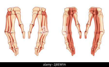 Hände Skelett Mensch Vorderansicht hinten. Satz von Karpalen, Handgelenk, Metacarpalen, Pals. Anatomisch korrektes 3D realistisches, flaches natürliches Farbkonzept Vektordarstellung isoliert auf weißem Hintergrund Stock Vektor
