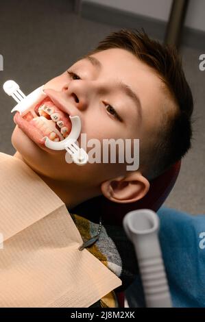 Besuch beim Kieferorthopäden, Installation von Zahnspangen an den oberen Zähnen, weißer Retraktor auf den Lippen des Kindes, Ausrichtung der Zähne. Stockfoto