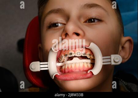 Besuch beim Kieferorthopäden, Installation von Zahnspangen an den oberen Zähnen, weißer Retraktor auf den Lippen des Kindes, Ausrichtung der Zähne. Stockfoto