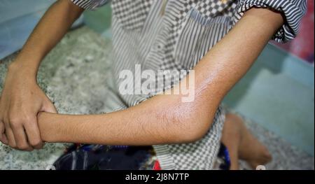 Supracondylar Fraktur oder gebrochene Ellenbogen bei asiatischen, 11-jährigen Kind. Fraktur des distalen Oberarmknochens in der Nähe des Ellenbogens. Verursacht durch einen Sturz auf ausgestreckte e Stockfoto
