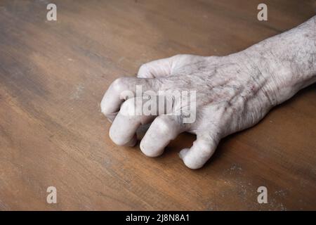 Volkmann Kontraktur im linken oberen Teil des älteren Mannes aus Südostasien. Es ist eine dauerhafte Verkürzung der Unterarmmuskulatur, die zu einem klawähnlichen Po führt Stockfoto